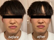 もみの木鍼灸整骨院 恵比寿/初回のみ美容鍼ビフォーアフター