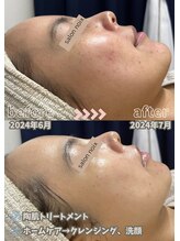 サロンノワ(salon noix)/《１か月後のお肌の変化》