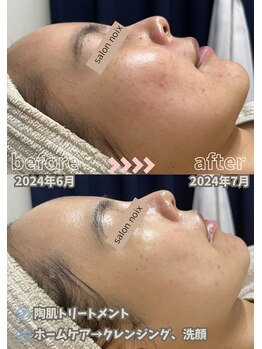 サロンノワ(salon noix)/《１か月後のお肌の変化》