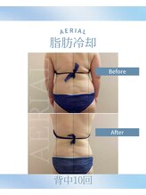 エアリアル 武雄店/脂肪冷却