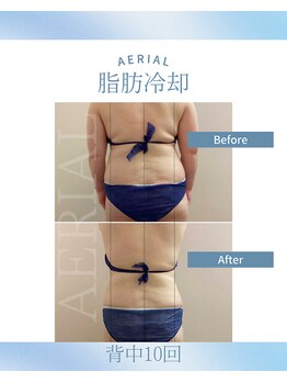 エアリアル 武雄店/脂肪冷却