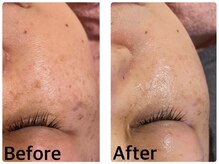 マインドエステ 仙台店(mindエステ)/シミ・くすみ◇ビフォーアフター