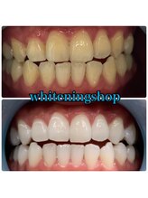 ホワイトニングショップ 武蔵小杉店/武蔵小杉ホワイトニング美白ケア