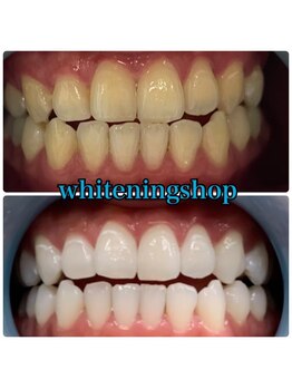 ホワイトニングショップ 武蔵小杉店/武蔵小杉ホワイトニング美白ケア