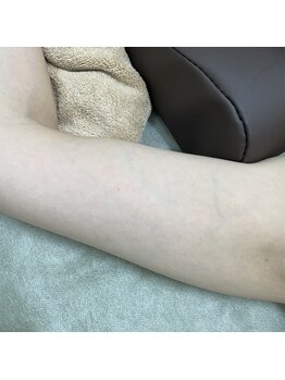 ナノハナ/鹿沼市の全身脱毛のナノハナ