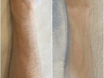 エレヌイ(ELENUI)/美肌脱毛★最新光フェイシャル