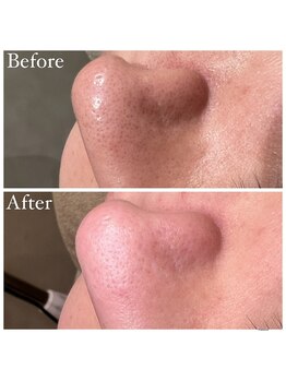 マドモアゼル 麻布十番/毛穴洗浄