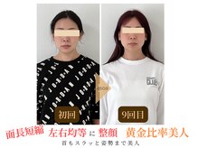 エソア(esoa)/40代　小顔矯正