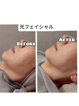 イージープラス つくば店(EASY+)/光フェイシャル