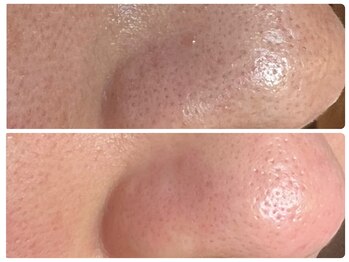 カピリナ(ka pilina)/詰まり毛穴、つるん肌へ