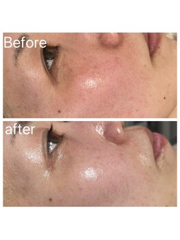 ミチル(Michill)/バクテリウムピール(W)