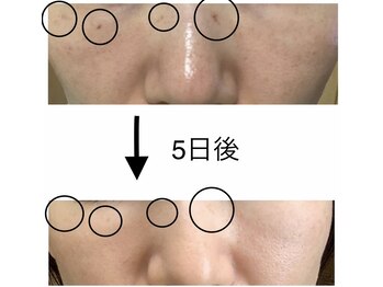 ミニン(minin)/シミケア