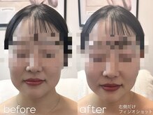 ブリエ(Briller)/フィジオショット