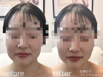 ブリエ(Briller)/フィジオショット