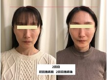ナチュレアンドメディカ(Nature&Medica)/【たるみor小顔】オンダフェイス