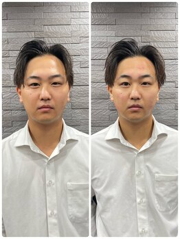 長寿鍼灸院 長寿整骨院/men's美容鍼50本効果★