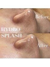 ファミーユ 太田(Fameu)/毛穴洗浄　ハイドロスプラッシュ