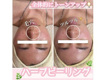 サロン(SALON)/ハーブピーリング