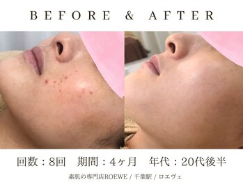 ロエヴェ(ROEWE)/ニキビ改善・毛穴ケア・肌質改善