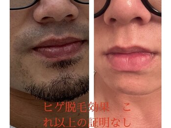 スムース イー(Smooth+E)/ツルツル肌に◎ヒゲ脱毛♪