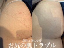 ルアナアイナ(Luana Aina)の雰囲気（ハーブピーリング【お尻】実は大人気です★黒ずみ、毛穴にも◎）