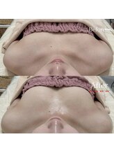 ビューティーサロン シンデレラ 心斎橋本店(Cinderella)/バストケアで肩こり巻き肩も改善