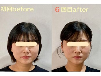 エスポワール(espoir)/初回before・６回目after