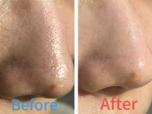 リピート続出！大人気【ハイドラ毛穴洗浄】1回でこの結果☆