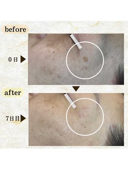 イデアーレ(ideale)/50代シミ1週間で排出プログラム