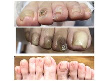 ウォーク(Walk)の雰囲気（長年諦めていた足爪、改善します!!）