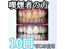 ホワイトニングショップ 長崎店/ホワイトニング