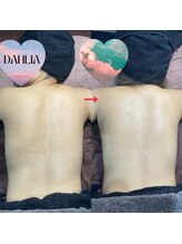 ダリア(Dahlia)/ハーブピーリング【背中】