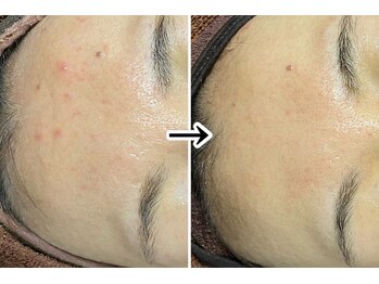 おうちサロン ミキ/3種類のピーリングでお肌改善