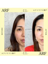 アーフ(ARF)/エクソリフト