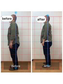 朱雀整骨院/姿勢矯正before after