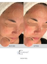 セローナ(Selona)/施術1回目 直後