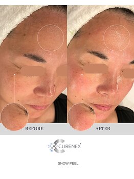 セローナ(Selona)/施術1回目 直後