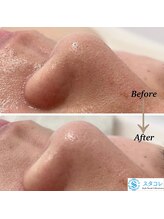 スタコレ スタイルブックコレクションズ 京橋店(Style Book Collections)/毛穴洗浄(１回での効果)