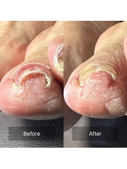 ぱんだ鍼灸接骨院 明里橋院/巻き爪施術一回目