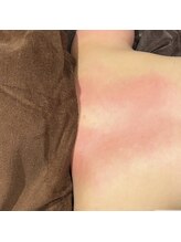 オアシスサカエ(OASIS SAKAE)/【痩身】肩甲骨☆