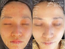 ベル 桜木町(Belle)/ハーブピーリング｜ニキビケア