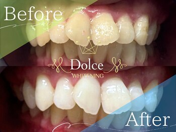 ドルチェ(Dolce)/ビフォーアフター