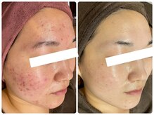 フルリールボーテ(Fleurir Beaut)/ニキビ毛穴