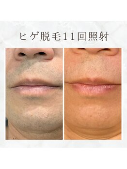 ボゴス(BOGOSS)/ヒゲ脱毛11回照射