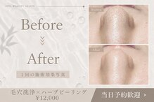 エピル(EPIL)