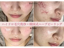 レクラ バイ ドクターエイチ(L'ECLAT by Doctor.H)の雰囲気（毛穴/赤み/くすみ/ニキビケア隠す肌から、見せたくなる肌へ）