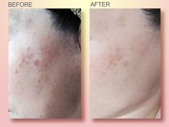 ジュリア オージェ 天王寺店/ビフォーアフター（シミケアP）