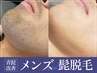 【メンズ髭脱毛】青髭改善/デザイン脱毛/髭脱毛の効果で美しいお肌へ