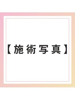 ブレア 銀座/施術写真【自律神経/虎ノ門/鍼】