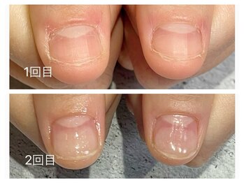 グレースレディ/(深爪/長さだし/フィルイン/)